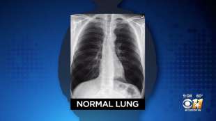 polmoni covid e fumatore 1