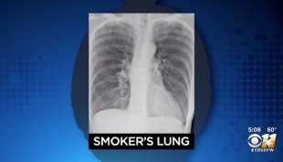 polmoni covid e fumatore 2