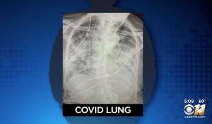 polmoni covid e fumatore 3