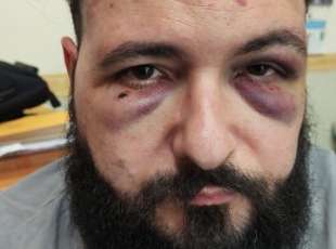 roberto tarallo - fotografo picchiato a napoli per la spilla antifascista