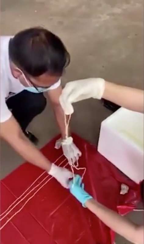 verme solitario di 18 metri nella pancia di un uomo in thailandia 1