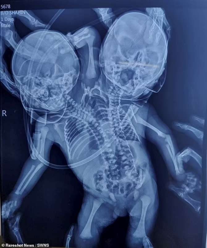Radiografia dei gemelli siamesi di Ratlam