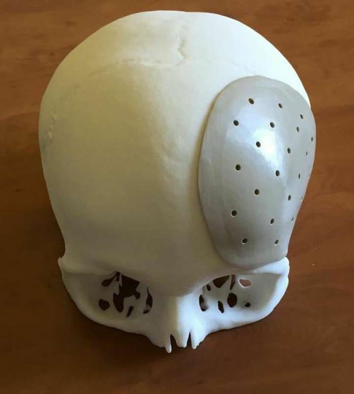protesi 3d cranio
