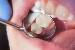 otturazione dentista 3