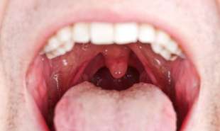 tumore bocca