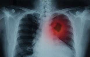 cancro ai polmoni 1