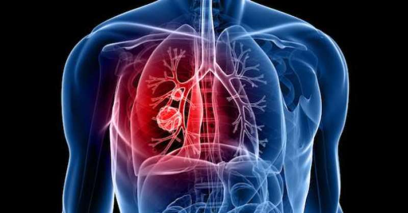 cancro ai polmoni 2