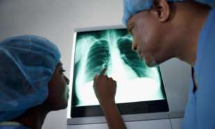 Malati di tumore al polmone 3