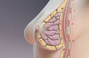 tumore al seno 2