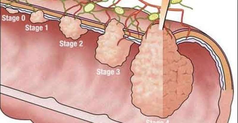tumore al colon 5