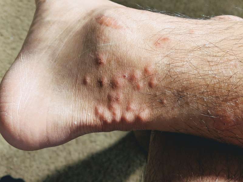 punture di zanzara caviglia