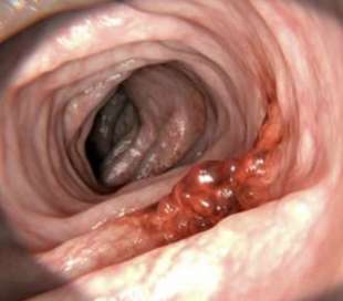 tumore al colon 1