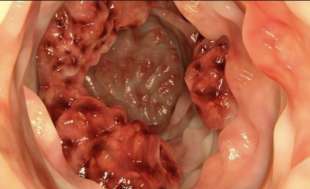tumore al colon 2