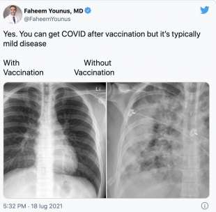 il tweet del dottor faheem younus polmoni di un vaccinato vs polmoni di un non vaccinato