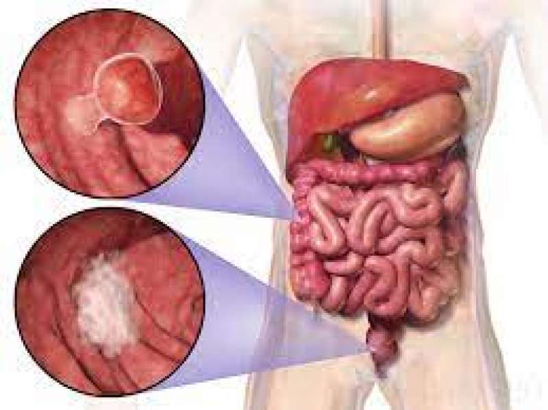 cancro colon retto 2