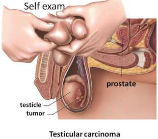 tumore testicolo 1