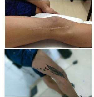tatuaggi per coprire cicatrici 1