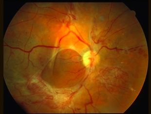 distacco della retina 1