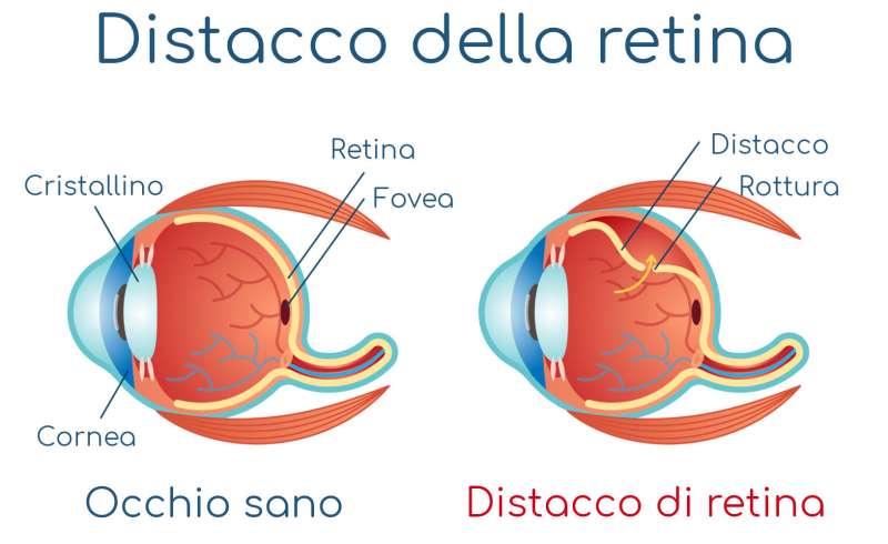 distacco della retina 4