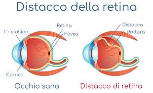 distacco della retina 4